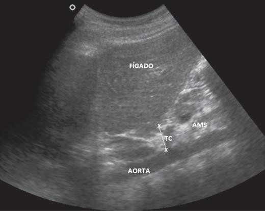 Figura 3. Ultrassonografia demonstrando a mensuração da distância entre a superfície posterior do lobo hepático esquerdo e a parede anterior da aorta (GIP 3).
