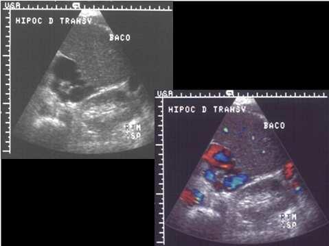 hepatomegalia/massa hepática palpável e/ou outros sinais e sintomas