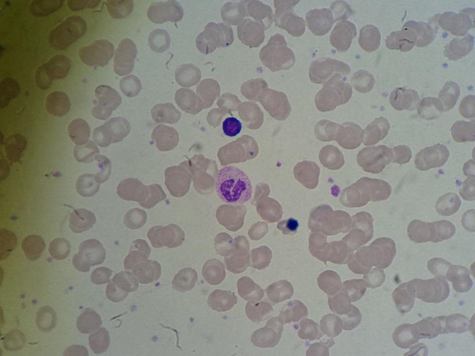 Tabela 17 - Hemograma utente V. Hemograma RBC 3 x 10!