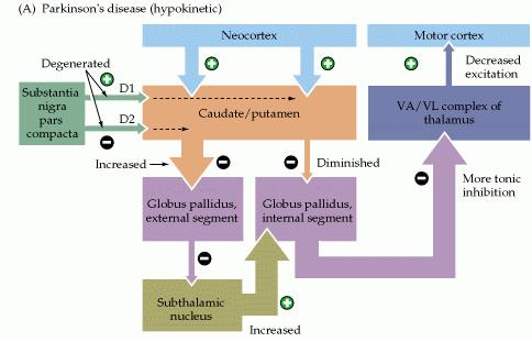 Discinésias Doença de Parkinson Perda progressiva dos neurónios dopaminérgicos