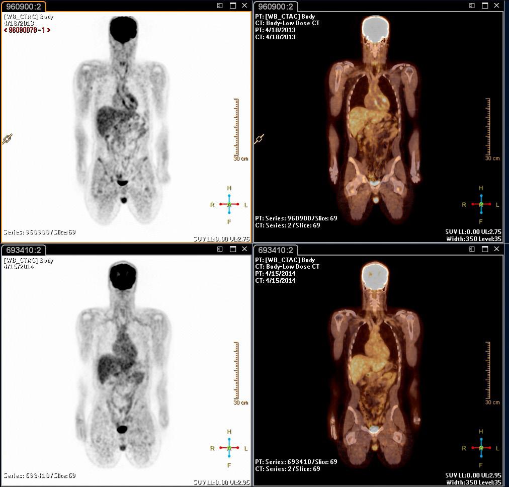 Felix e cols. PET-CT nas Doenças Cardiovasculares Inflamatórias Artigo de Revisão Figura 2 Na linha superior, observa-se captação de 18 F-FDG na aorta torácica e seus ramos.
