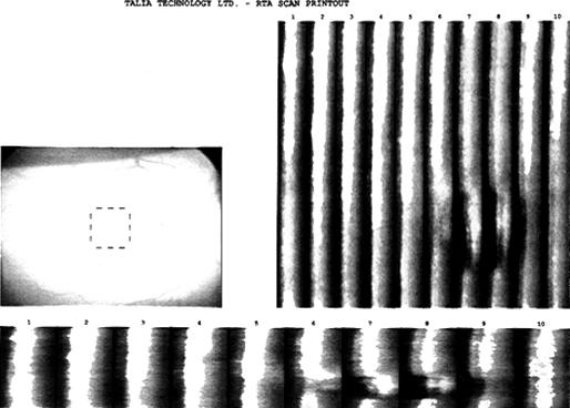 118 Analisador de espessura retiniana (RTA) na avaliação de buraco macular Classicamente, o buraco macular é diagnosticado e avaliado por meio de biomicroscopia do segmento posterior, retinografia e