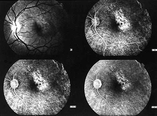 Dos dez olhos estudados, oito foram examinados antes de qualquer tratamento e dois foram examinados no pós-operatório de cirurgia para o buraco macular, que consistiu de vitrectomia via pars plana e