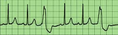 terceiro sempre é uma extrassístole. Os ritmos geminados podem ser supraventricular ou ventricular (FIGURA 86). 64 A B 1 2 3 4 5 6 7 8 1 2 3 4 5 6 FIGURA 86. A: bigeminismo supraventricular.