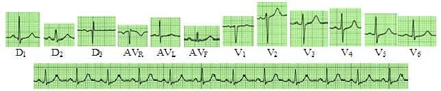 69 D 2 FIGURA 90. Laudo eletrocardiográfico 1. Veja abaixo que a única anormalidade encontrada foi na morfologia da onda T.