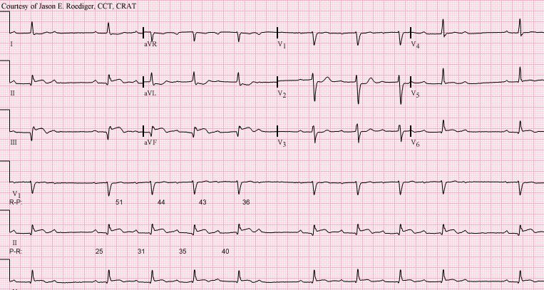 72 FIGURA 93. Laudo eletrocardiográfico 4. (Fonte: Di Jer5150 - CC BY-SA 3.0, https://commons.wikimedia.org/w/index.php?