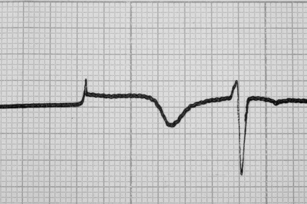 8 2. Noções preliminares. 2.1. O papel sobre o qual se imprime o traçado eletrocardiográfico (FIGURA 1). 1mm 5mm 5mm 1mm FIGURA 1. O Papel onde se imprime o traçado eletrocardiográfico.