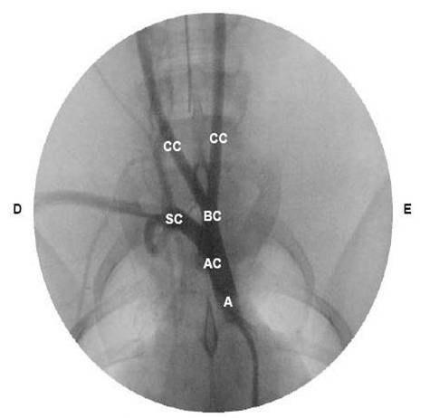 Figura 3 Imagem angiográfica evidenciando a aorta (A), arco aórtico (AC), troncobicarotídeo (BC), artéria subclávia direita (SC) e artérias carótidas comum (CC)