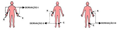 Atividade Elétrica do Coração 9 DII é a diferença de potencial entre o membro inferior esquerdo e eletrodo ativo e o membro superior direito, eletrodo referencia.
