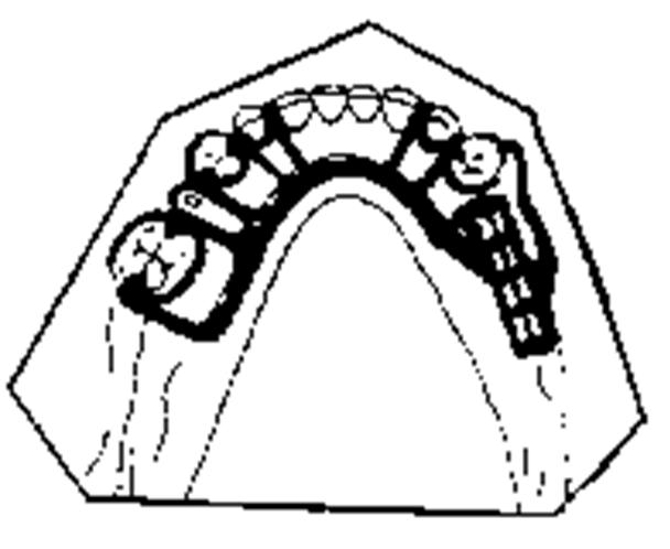 entre as raízes dos dentes anteriores, dificultando a fala. Uma placa palatina anterior pode bloquear a passagem de ar/saliva, proporcionando maior conforto para o paciente.