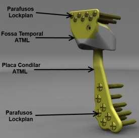 Fossa Temporal ATML (produto acabado) A Fossa Temporal ATML é o item responsável pela fixação da parte superior da prótese ao osso.