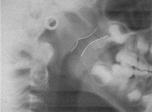 222 Introdução A respiração nasal é estímulo para o desenvolvimento e crescimento dos espaços funcionais nasal, oral e faríngeo.