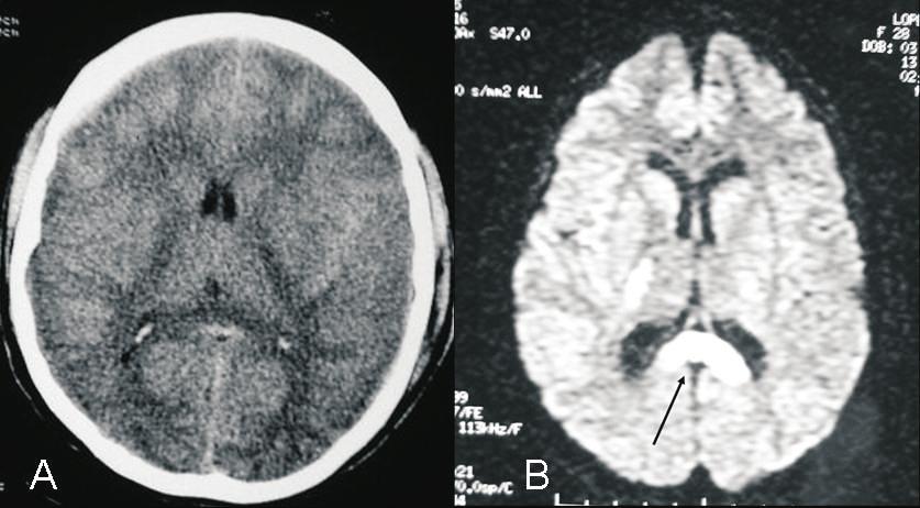 34 Lesões difusas no traumatismo craniencefálico: aspectos clínicos, fisiopatologia e classificação. - Almir Ferreira de Andrade e cols.