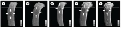 FIGURA 3 - Radiografias das tíbias das ratas dos grupos I, II, III, IV e V mostrando a reparação óssea aos sete dias. (setas). Escala de alumínio posicionada no canto inferior direito.