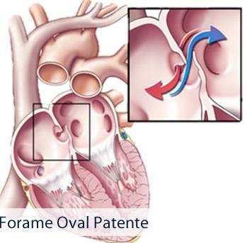 TERATOLOGIAS CARDÍACAS Persistência de arco aórtico direito: não degeneração da aorta dorsal direita Bovinos, suínos, equinos,