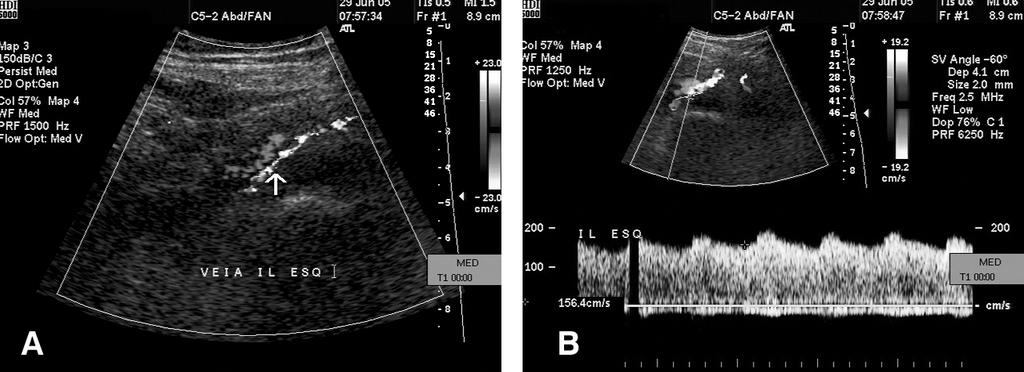 226 J Vasc Bras 2006, Vol. 5, Nº3 Eco-Doppler e fístula arteriovenosa na TVP Barros FS et al. Figura 2 - Segundo caso.