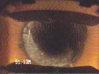 1B: Sapata - Após o tubulão, existe no poço uma sapata de cimento até os 93,47 metros.