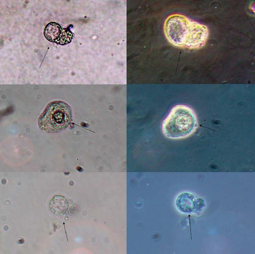 Figure 1 Three decoy cells presented under bright field microscopy (left panel)