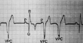 ! Ritmo cardíaco! Efeito Arritmogênico Complexos Ventriculares Prematuros associados ao Halotano Sensibilização do miocárdio às catecolaminas, sevofluorano e desfluorano Sem potencial arritmogênico!