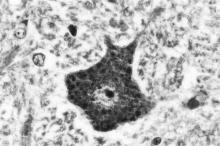 Masson, evidenciou-se núcleo acidófilo e citoplasma basófilo.