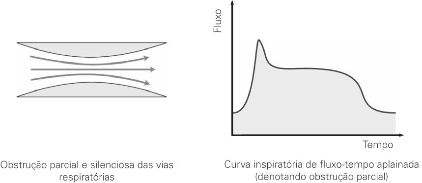 Limitação do fluxo Conforme a via respiratória superior começa a se contrair, a forma da curva fluxo inspiratório-tempo muda.