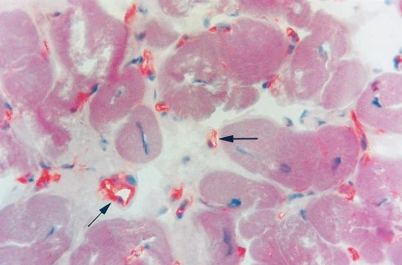 Biópsia Miocárdica Marcação Imunohistoquímica - Permite caracterização precisa do tipo de infiltrado inflamatório - A expressão de Ag do CMH é mais difusa que as alterações histológicas - Menor