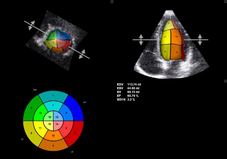 FEj VE RMC (%) Ecocardiografia - Não existem alterações ecocardiográficas específicas: - Alteração da cinética segmentar/ função global - Hipertrofia ventricular transitória (em cerca de 15%) -