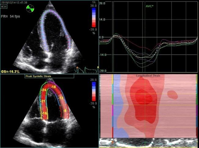 FEj VE RMC (%) Ecocardiografia - Speckle Tracking na