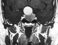 6 Adenomas pituitários: considerações cirúrgicas, uma visão geral A sela túrcica contém diferentes tipos de tecidos e como tal é sede de uma grande variedade de tumores 47.