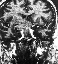 8 secreção, restaurar a função endócrina e, nos casos dos grandes tumores, descomprimir as estruturas neurovasculares intracranianas 1,4,22,33.