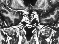 Existe um consenso de que os microadenomas, os macroadenomas intra-selares e os macroadenomas com extensão esfenoidal podem ser operados pela via transesfenoidal.