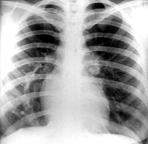 ANOMALIA VASCULAR DO PULMÃO DIREITO