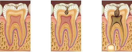Esmalte formado por sais de cálcio, envolve a dentina na região da coroa; na raiz a dentina é revestida pelo cemento.