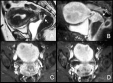 subendometriais ou adenomiose [15]. A histerossonografia pode visualizar lesões endocavitárias e permite diferenciar doença endometrial da subendometrial.