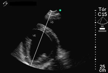 Figura 2 - Imagem ecocardiográfica em modo-b da vista de eixo menor do ventrículo esquerdo de equinos Quarto de Milha, obtida pela janela paraesternal direita.