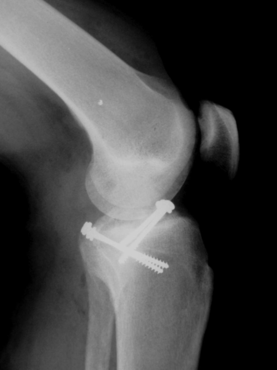 584 rev bras ortop. 2013;48(6):581 585 Figura 6 Radiografia do joelho seis meses PO, que evidencia redução anatômica e consolidação. em adultos.