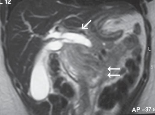 Labrunie EM, Marchiori E Figura 4. Intussuscepção gástrica. : Tomografia computadorizada ao nível da terceira porção duodenal.