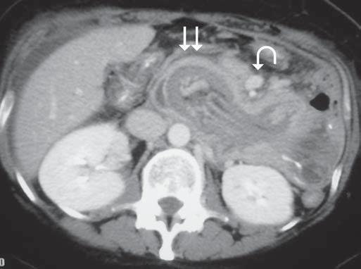 : Ressonância magnética em coronal T2 evidenciando dilatação biliar e estiramento do colédoco (seta) pela invaginação do estômago excluído para dentro do arco duodenal (duas setas).