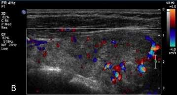 Note que os parâmetros dos ajustes do aparelho são os mesmos As imagens ultrassonográficas da glândula tireoide de cada um dos pacientes incluídos nesta pesquisa, em cada um dos tempos do exame,