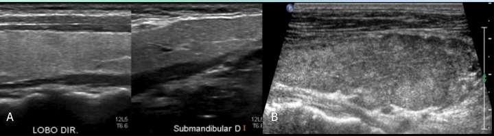 Métodos 21 Figura 7 - Análise da ecogenicidade: Imagens dos cortes longitudinais dos lobos tireoidianos em modo-b.