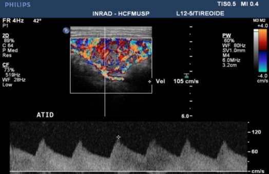 Métodos 25 Figura 11 - Imagem do US-Doppler pulsado mostrando o posicionamento do cursor para melhor mensuração da velocidade de pico sistólico na artéria tireóidea inferior direita, logo antes de