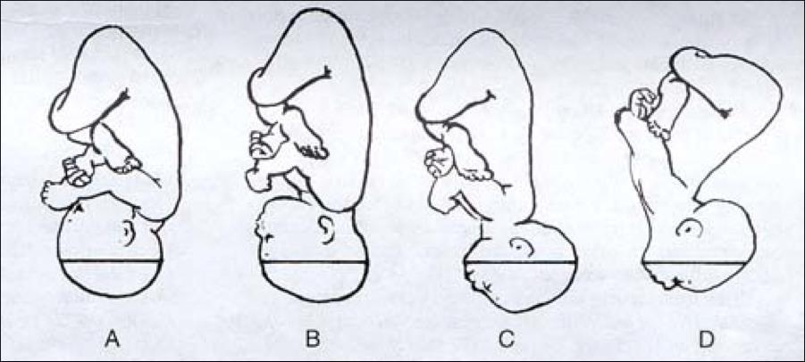 45. Marque a alternativa CORRETA: A) A figura A representa apresentação cefálica fletida de vértice e a linha de orientação é a sutura coronal.