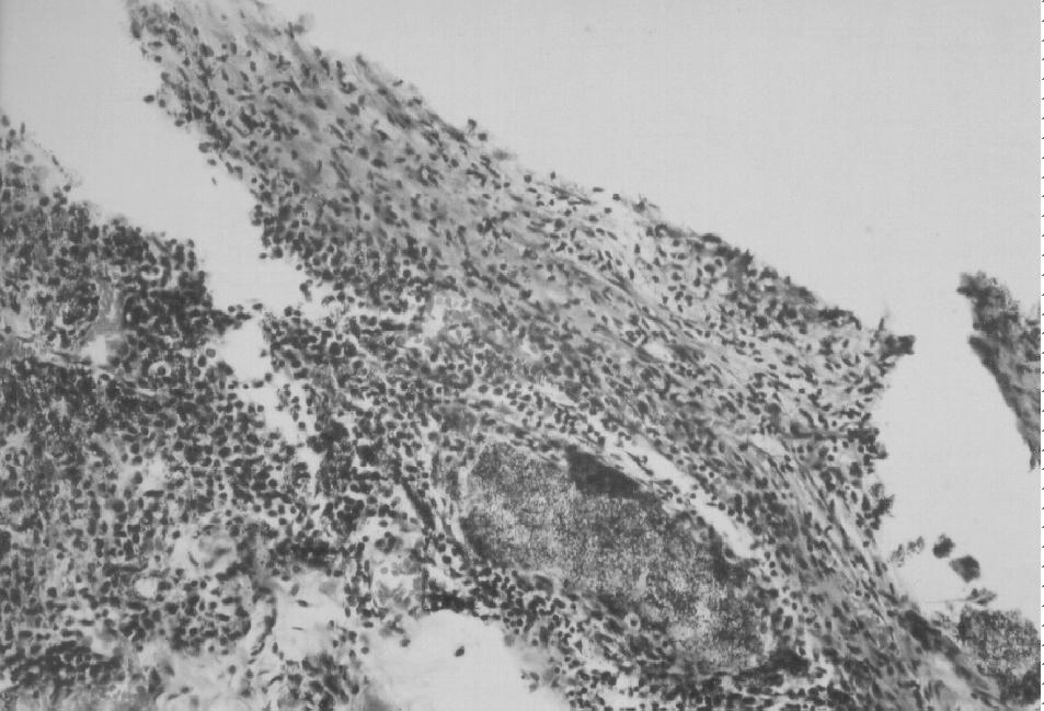 O cimento Apexit, por sua vez, provocou reação mais agressiva, com aumento no número de células gigantes inflamatórias, nos três períodos de observação.