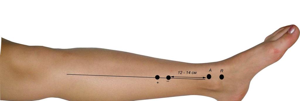 Técnica do Estudo do Nervo Safeno Interno Valores de normalidade: Amplitude da resposta sensitiva 9±3,4 µv.