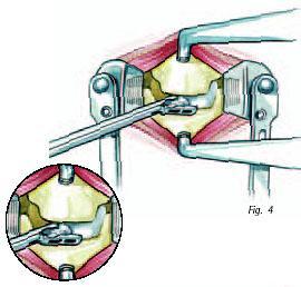 A abertura completa de espaço do disco intervertebral é realizada utilizando várias pinças de preensão, curetas e espátulas afiadas (Fig.4).