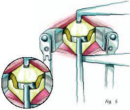 Utilizando uma broca de alta velocidade para remover a borda posterior e/ou osteófitos dorsais, grande cuidado deve ser tomado a fim de evitar danificar as placas terminais do corpo vertebral.