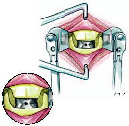 A parada na extremidade distal da manga garante que o implante não seja inserido muito longe no espaço intervertebral.