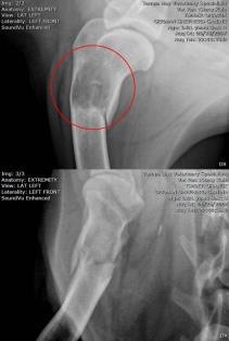 ósseo estresse resultante de traumatismo