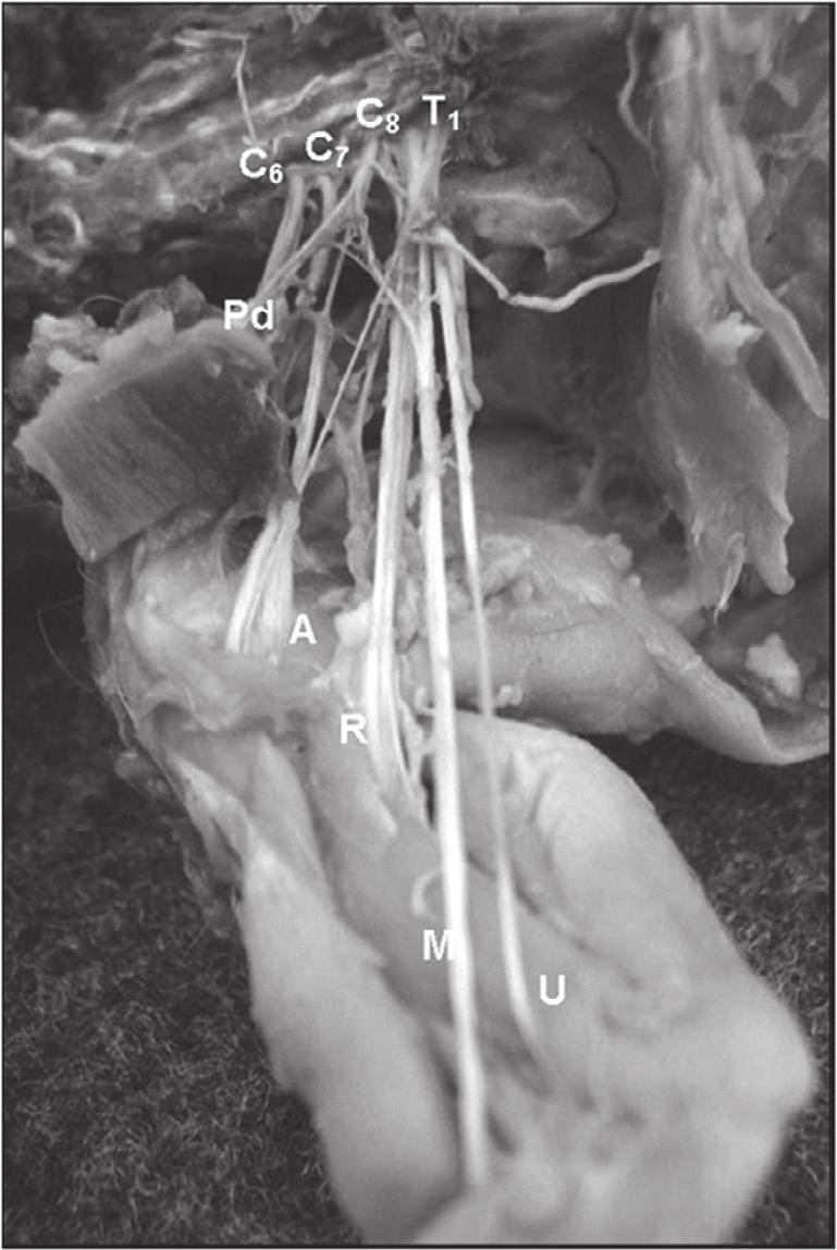 cutânea da parede ventral torácica e abdominal e pela motilidade do músculo cutâneo do tronco; e o nervo torácico longo (Figura 1) que é proveniente de C7 e C8 e após a anastomose das raízes que o