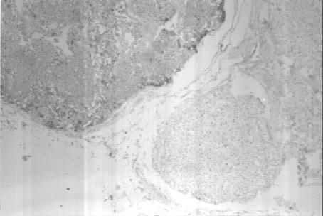 Portanto, ele tem uma caracterização diversa de um tumor de coalisão em que os dois componentes celulares estão lado a lado, com características imunohistoquímicas próprias (6).